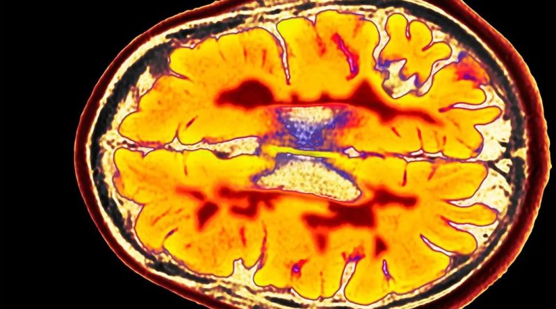 یک کشف مهم درباره MS ؛ نقش مهم باکتری هایی که میزبان حیوانی دارند در بروز بیماری!