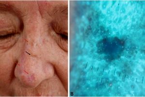 مصرف پروتئین آب پنیر موجب آکنه می‌شود؟
