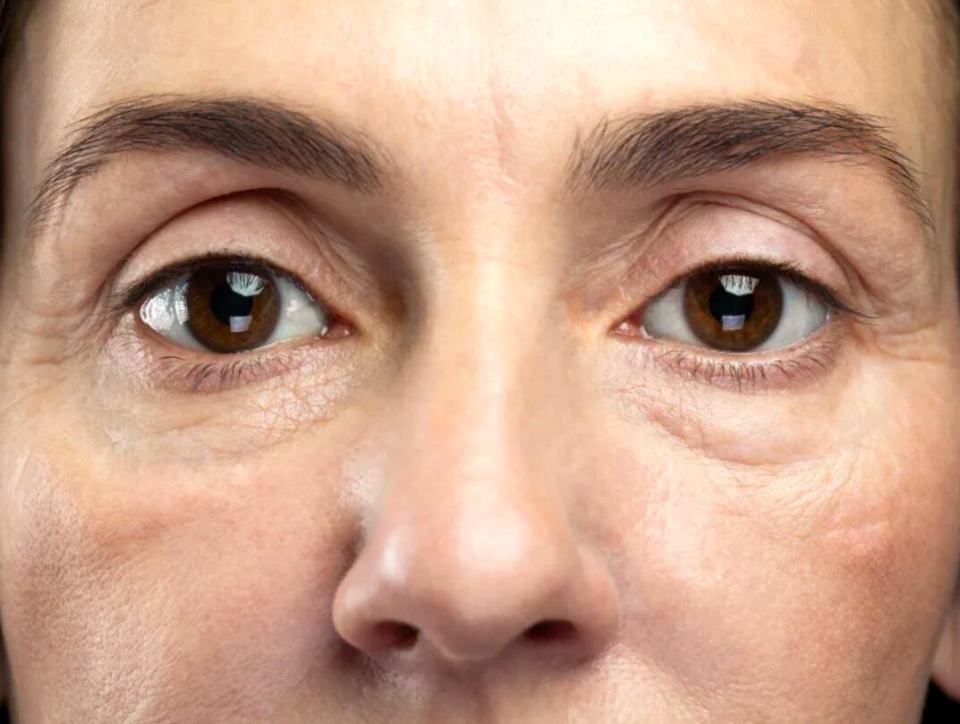 پف زیر چشم و درمان آن_صبح سریع 4 پف زیر چشم و درمان آن