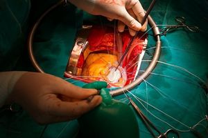 پزشک شیرازی دریچه قلب از بافت بدن بیمار ساخت