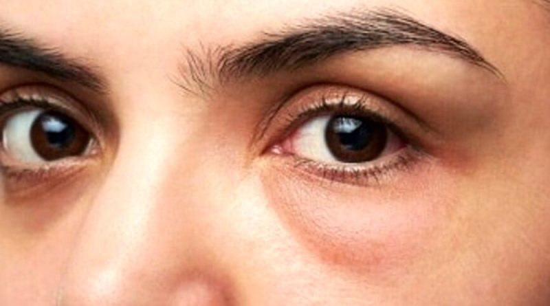 پف زیر چشم و درمان آن