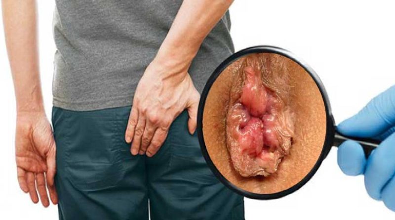 هزینه جراحی بواسیر با لیزر بهترین روش و کمترین مشکلات