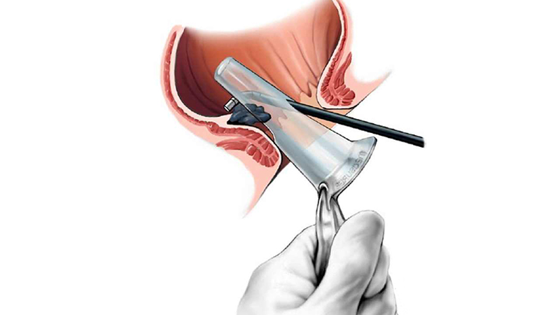 هزینه جراحی بواسیر با لیزر بهترین روش و کمترین مشکلات 4 2 1