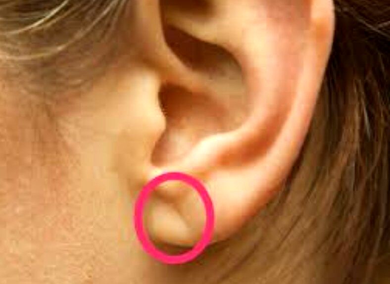 چین‌خوردگی‌های لاله گوش، خبر از یک بیماری مهم می‌دهد/ عکس