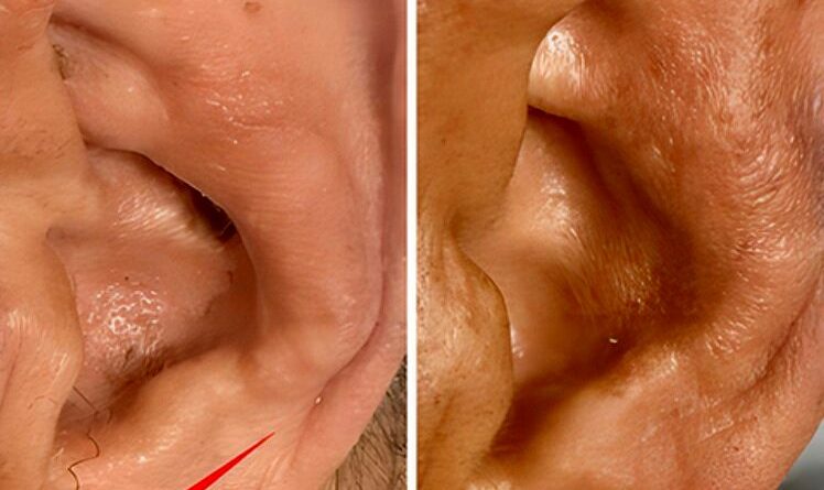 چین‌خوردگی‌های لاله گوش، خبر از یک بیماری مهم می‌دهد/ عکس