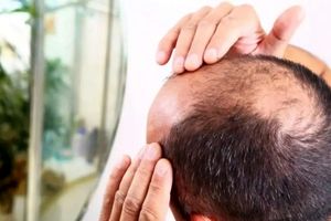 کشف تصادفی درمان طاسی