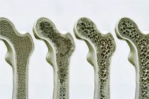 کشفی که می‌تواند درمان پوکی استخوان را متحول کند